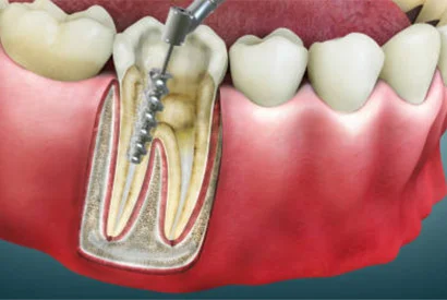 Cavities in milk teeth: do they really need filling?