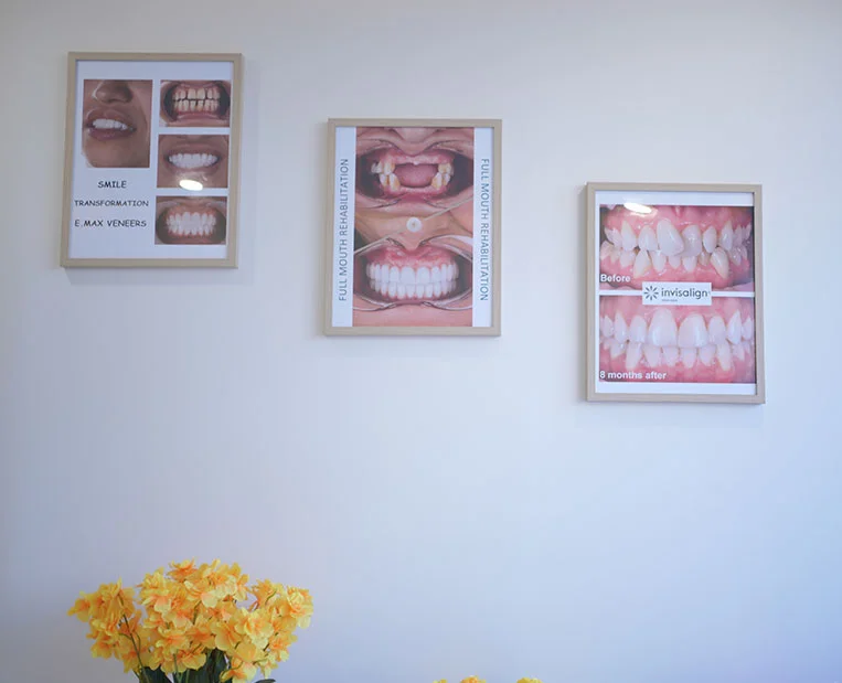 Composite vs silver fillings: which filling material is right for you?