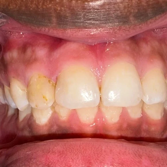 Chipped Tooth Repair after treatment