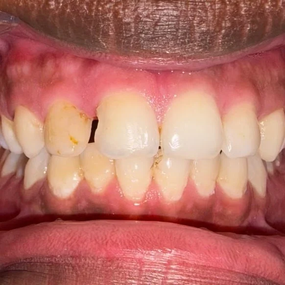 Chipped Tooth Repair before treatment