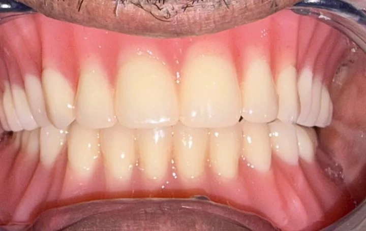 Dentures after treatment