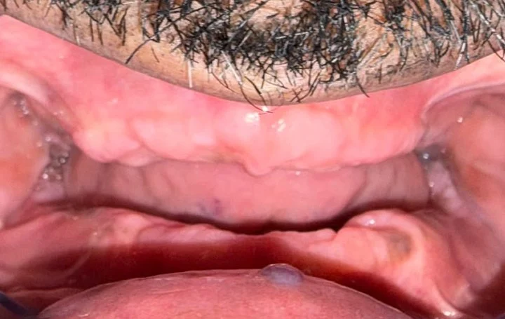 Dentures before treatment