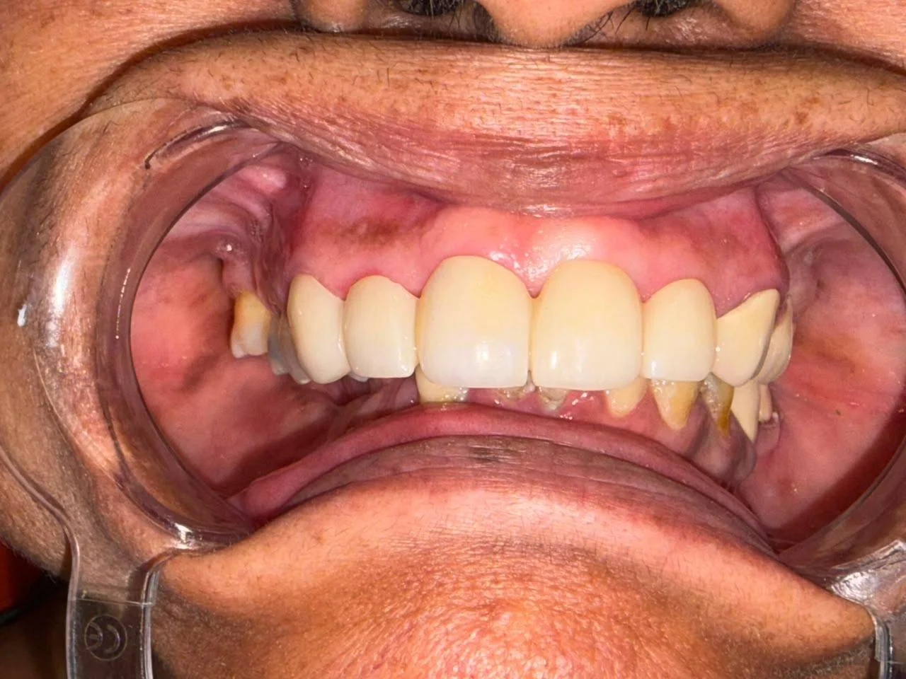 Crowns & Bridges after treatment