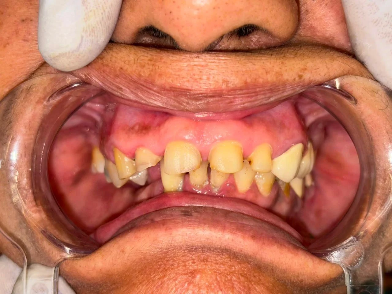 Crowns & Bridges before treatment