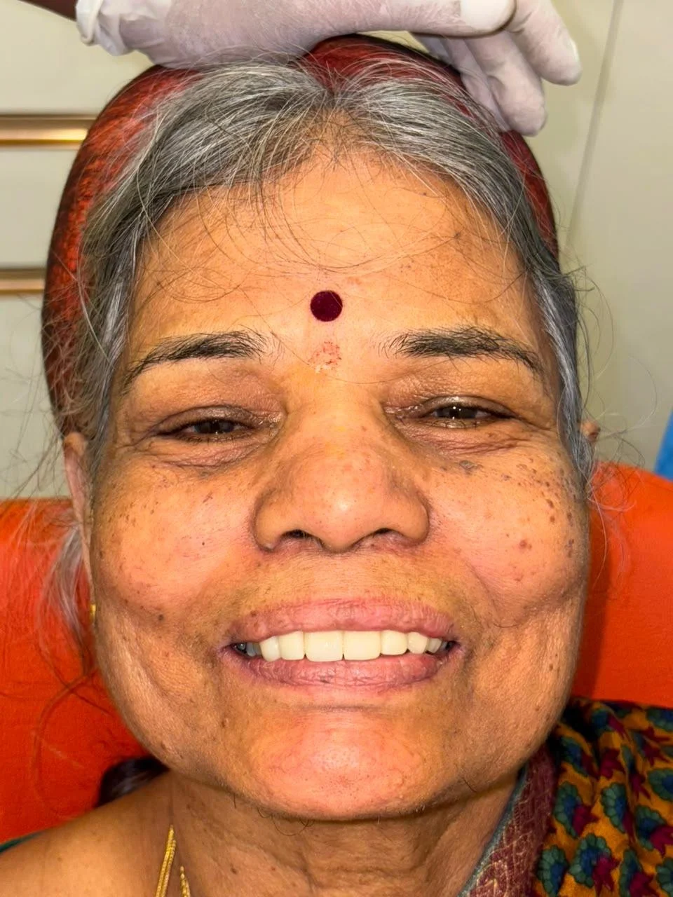 Smile Makeover after treatment