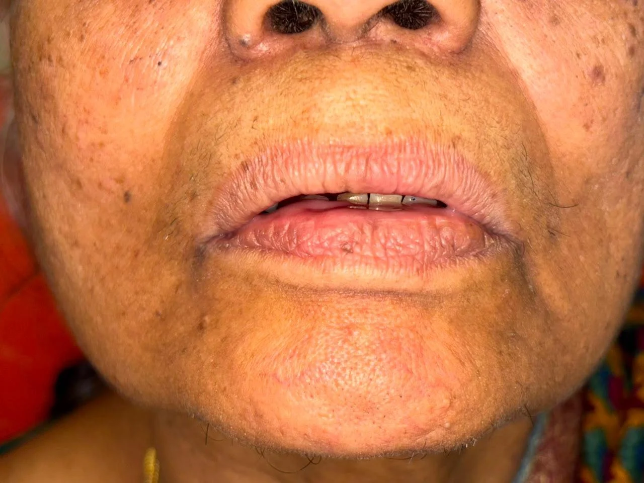 Smile Makeover before treatment