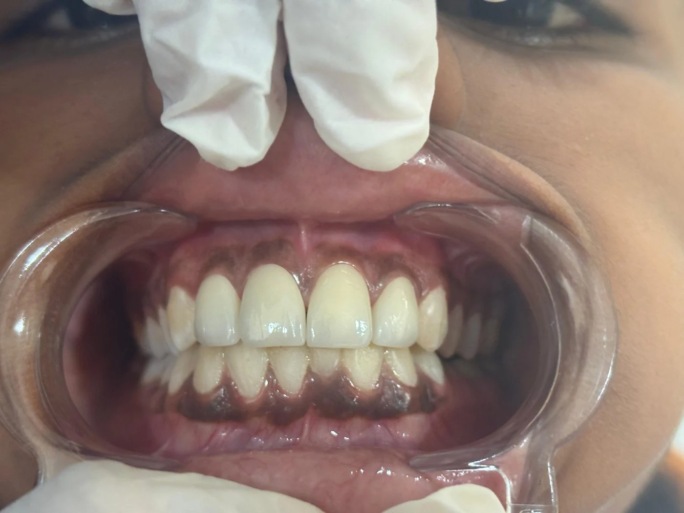 Veneers after treatment