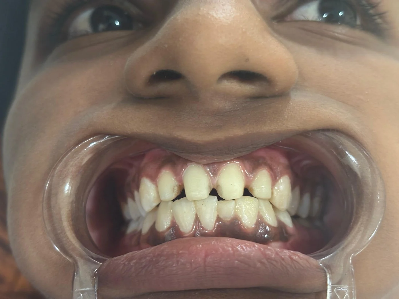 Veneers before treatment