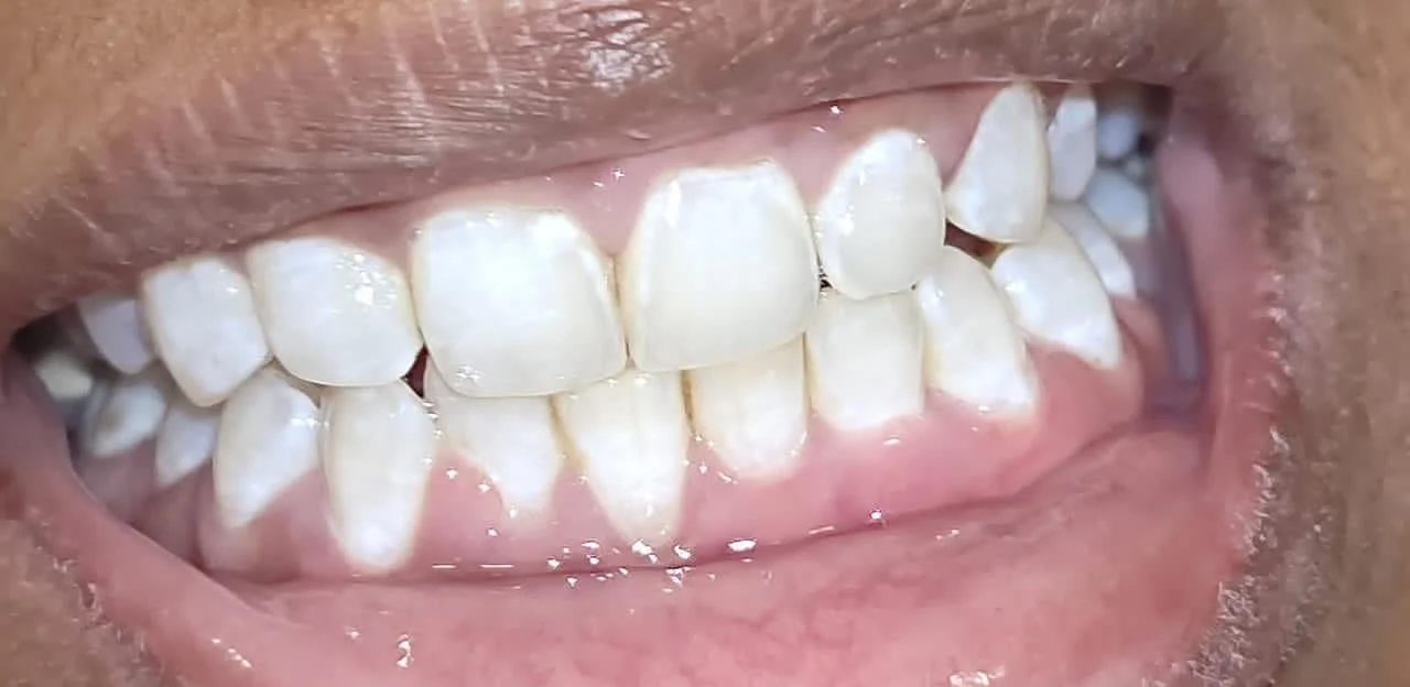 Teeth Whitening after treatment