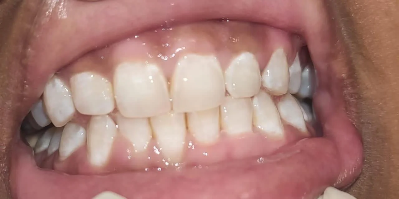 Teeth Whitening before treatment