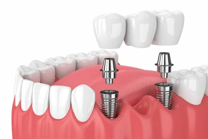 Dental implant treatment at Apollo Dental Vadavalli